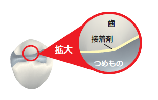 銀歯の二次むし歯